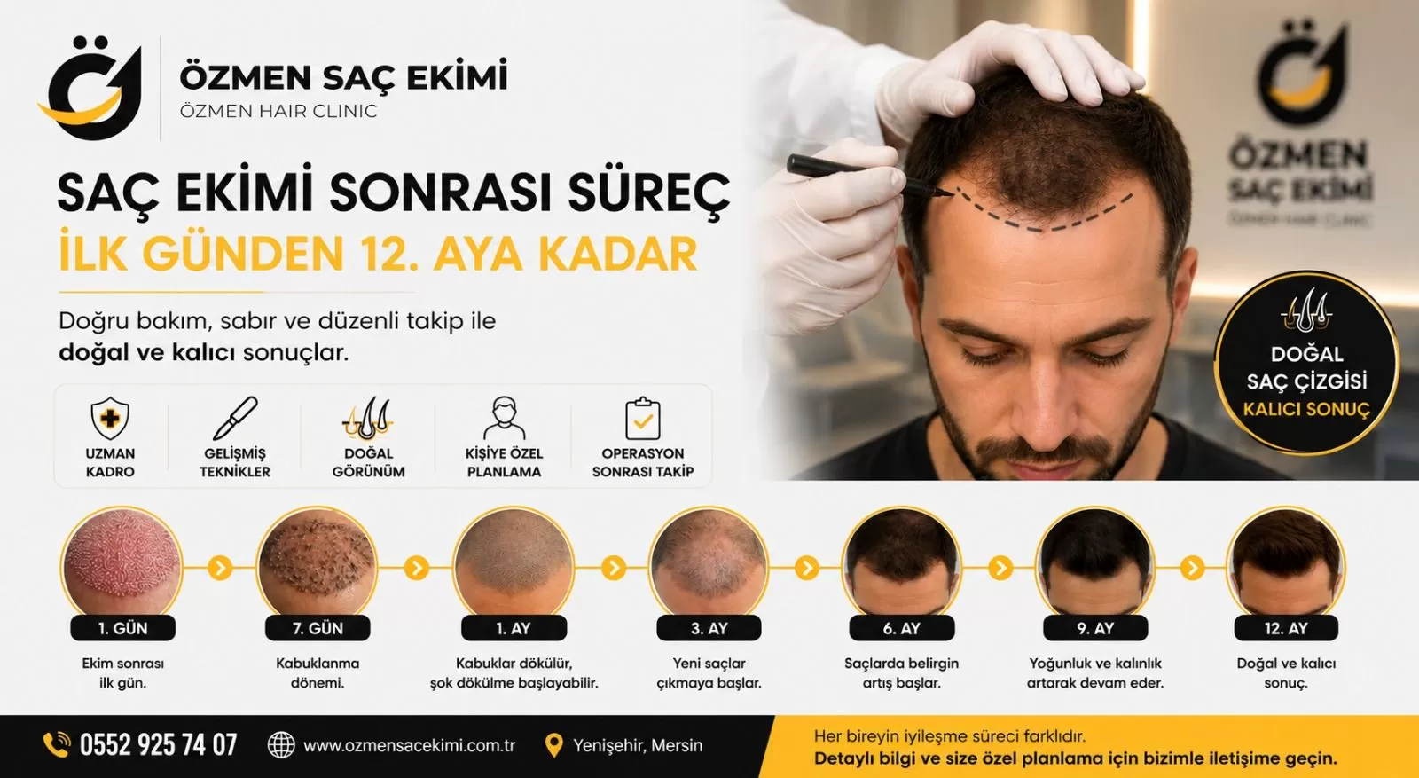 Mersin Saç Ekimi Sonrası Süreç İlk Günden 12. Aya Kadar Bilmeniz Gerekenler