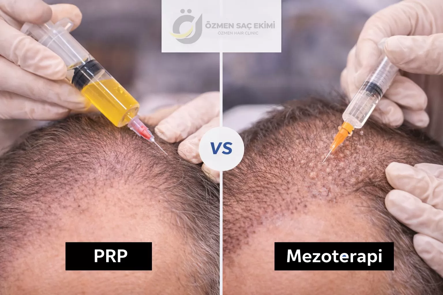 PRP ve Saç Mezoterapisi